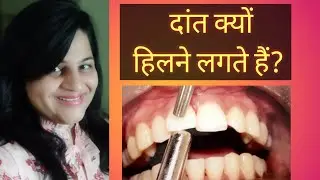 दांत हिलने के कारण |Daant dhile kyu ho jate hai |Tooth Mobility| dant hilne ka ilaj|Dant majbut kare