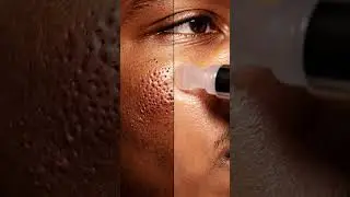 &ldquo;Most Satisfying Full Face Extraction You&rsquo;ll Ever See 😱&rdquo;Oddly Satisfying Blackhead Removal