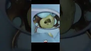 Unlock Root Canal Success  Symmetry, Shaping, and YouTube Secrets!