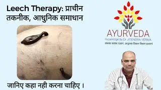 Leech Therapy: कहा नही करना चाहिए । प्राचीन तकनीक, आधुनिक समाधान  