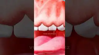 C&rsquo;est quoi les gencives envahies ? 😰