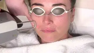 LIPSTICK LINES & SMOKERS LINE REMOVAL