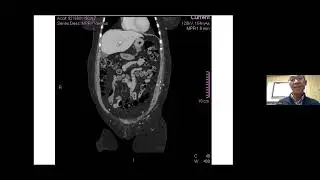 G-ECHO Surgical Fellows : Gastric Cancer