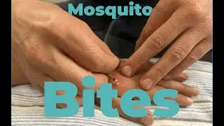 Dispersive Moxa?! How Using Moxa Can Disperse Mosquito Bites and Take Away That Itch