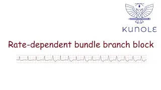 Bradycardias and conduction disorders (3.6). Rate-dependent bundle branch block