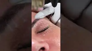 OPUS COLIBRI treatment