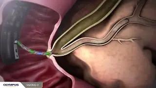 Selective Ductal Navigation Using VisiGlide 2 Guidewire