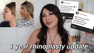 1 YEAR RHINOPLASTY UPDATE + Q&A (NOSE JOB IN MEXICO)