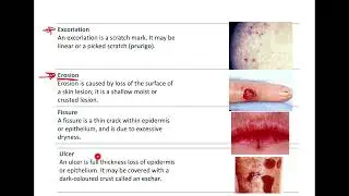 L2 Part 2 (functions, 1ry and 2ry skin lesions) Derma41