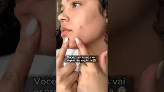 Voc&ecirc; espreme suas espinhas?😱N&atilde;o fa&ccedil;a mais isso!