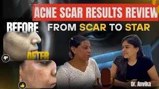 Acne scar result review -