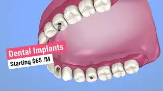 Same Day Smile Makeover - All on 4