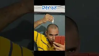 Tdc advance hair growth kit review day-68