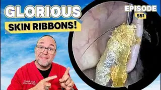 GLORIOUS Skin RIBBONS! Episode 551