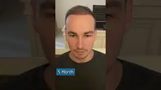 Vorher Nachher nach einer Haartransplantation 💪 | Elithair #shorts
