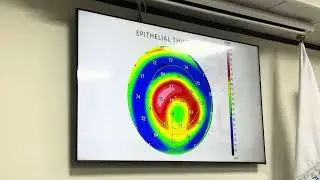 Part 3 - See things like never before in-depth corneal analysis with MS-39 ADVANCED HD OCT