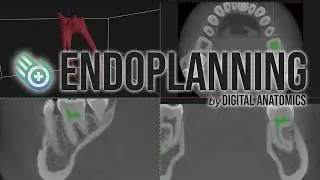 ENDOPLANNING - DIGITAL ANATOMICS - 3D ENDODONTIC PLANNING SOFTWARE