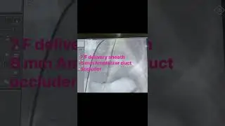 PDA DEVICE CLOSURE