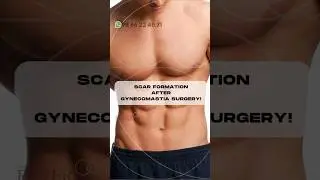 How to deal with scars after Surgery for Gynecomastia!?⭐ #ManBoobs