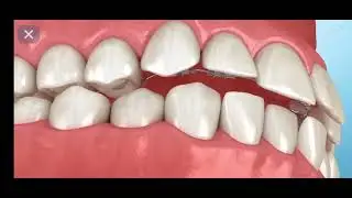 Correction of Malocclusion #orthodontics #Braces #misalignment
