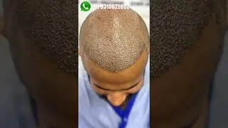 7Month Result | Hair Transplant | Hair Care | Best Clinic Delhi NCR | Divine Cosmetics Clinic #short