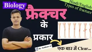 Types of bone fracture।। फ्रैक्चर के प्रकार।। #biology @Sudheersirji