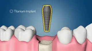 Dental Implant Surgery Explained - Dental Implants in NYC