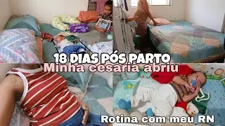 ROTINA 18 DIAS PÓS PARTO/FIZ LAQUEADURA  CUIDADOS COM MEU RN/AMAMENTAR DÓI.🩵 #viralvideo 