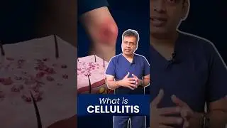 What is CELLULITIS Really?