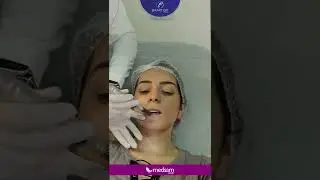 Microagulhamento Labial com a Dermapen da Smart GR