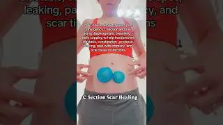 C-Section Scar Healing! #doctor #mom #csection #health #pregnancy #cupping #fyp #viralvideo #massage