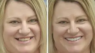 Digital Smile Design - Test Drive Your Smile -  Amy's Story Part Two