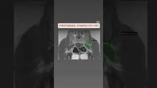 Piriformis syndrome MRI #shorts #viral #youtubeshorts