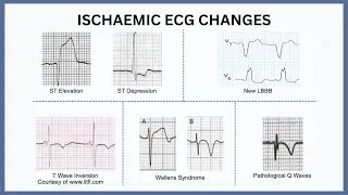 Ischaemic ECG Changes Explained