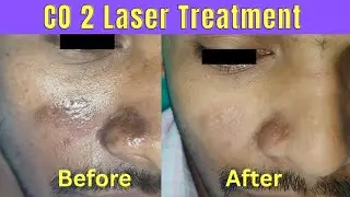 Laser treatment of facial scar | Scar treatment with CO2 laser | Best treatment of facial scar 