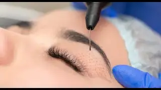 &iquest;Qu&eacute; es el plasmage? Blefaroplasma sin cirug&iacute;a