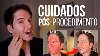Cuidados P&oacute;s Procedimentos (Como Cuidar Da Pele Depois De Lasers)