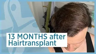 13 месяцев после пересадки волос &mdash; Elithairtransplant Dr. Balwi Turkey