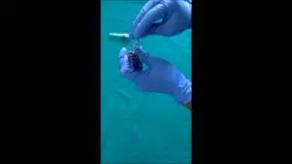 local anesthetic delivery using breech loading metallic non aspirating syringe