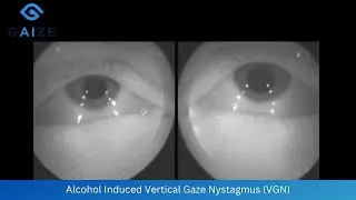 Alcohol Induced Vertical Gaze Nystagmus
