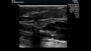 Tumescent anaesthesia along the vein