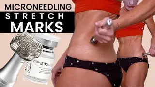 Erase Stretch Marks? LIVE Body Microneedling with Channel Pro Pen + Me Too Healer PDRN CH