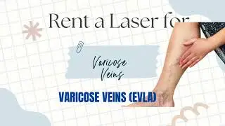 Flexible Laser Rental for Varicose Vein Treatment!