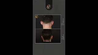 Prominent ear correction before and after &ndash; 3 years post-op