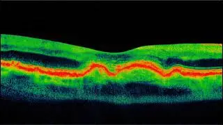 AI video of Drusen dissolving in the first 6 months of Accelerated Self Healing