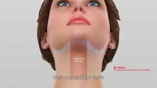 VMax HIFU Face Lift Machine