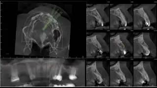 CBCT interpretation - unknown opacity at #10