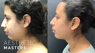Double Chin Removal Treatment - My CoolSculpting Experience in London
