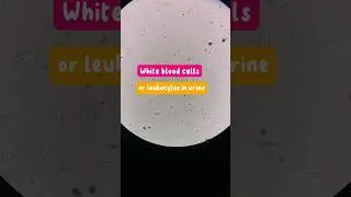 White blood cells in urine #urine #urinalysis #laboratory #microscope #UTI #urinarytractinfection