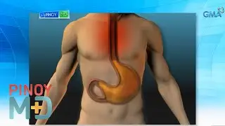 How to manage and prevent acid reflux | Pinoy MD